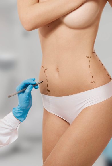 Plastic surgery doctor draw line on patient breast augmentation implant. Woman belly marked out for cosmetic surgery in surgery room interior